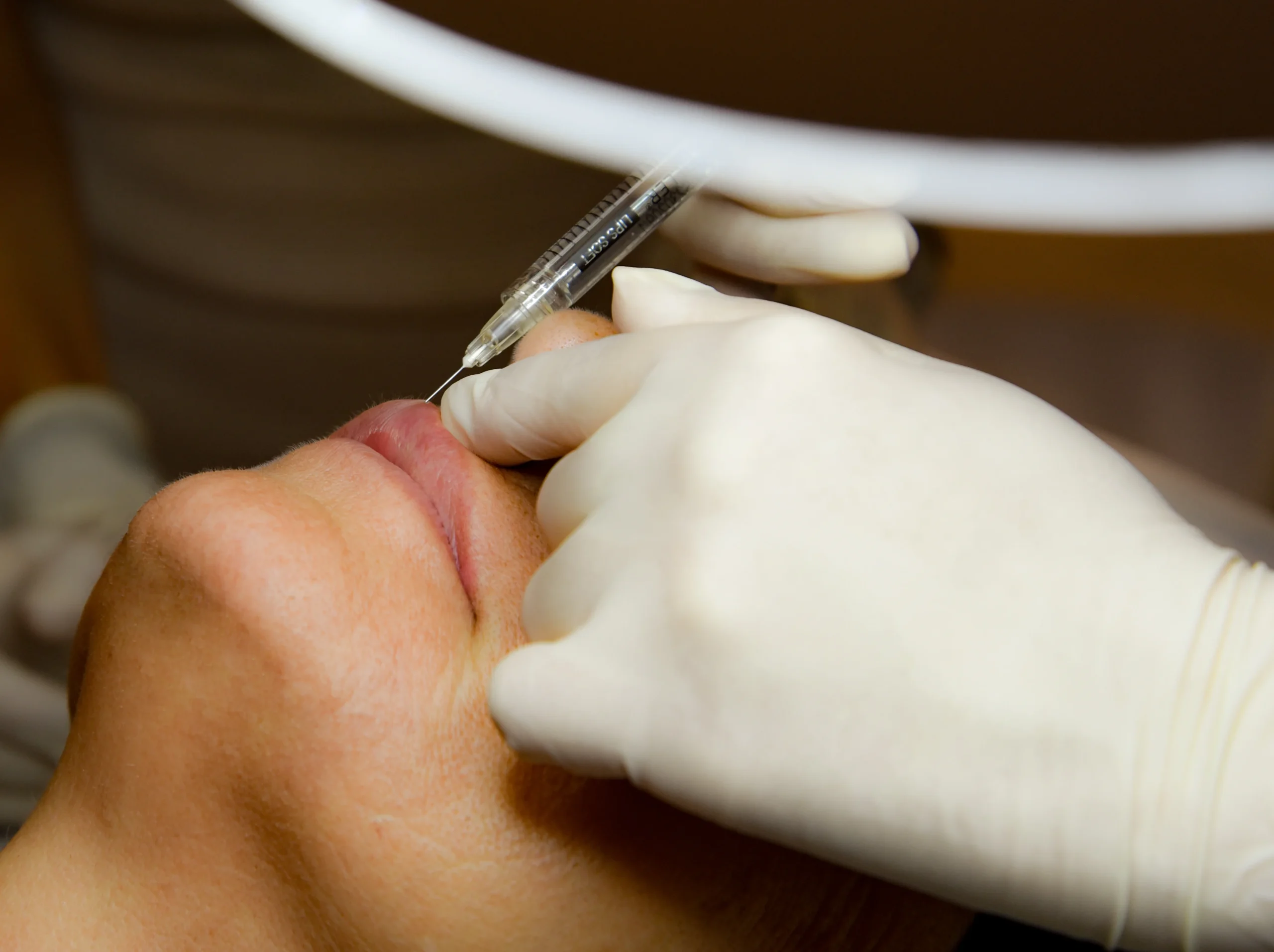 aumento-de-labios-en-cordoba-1