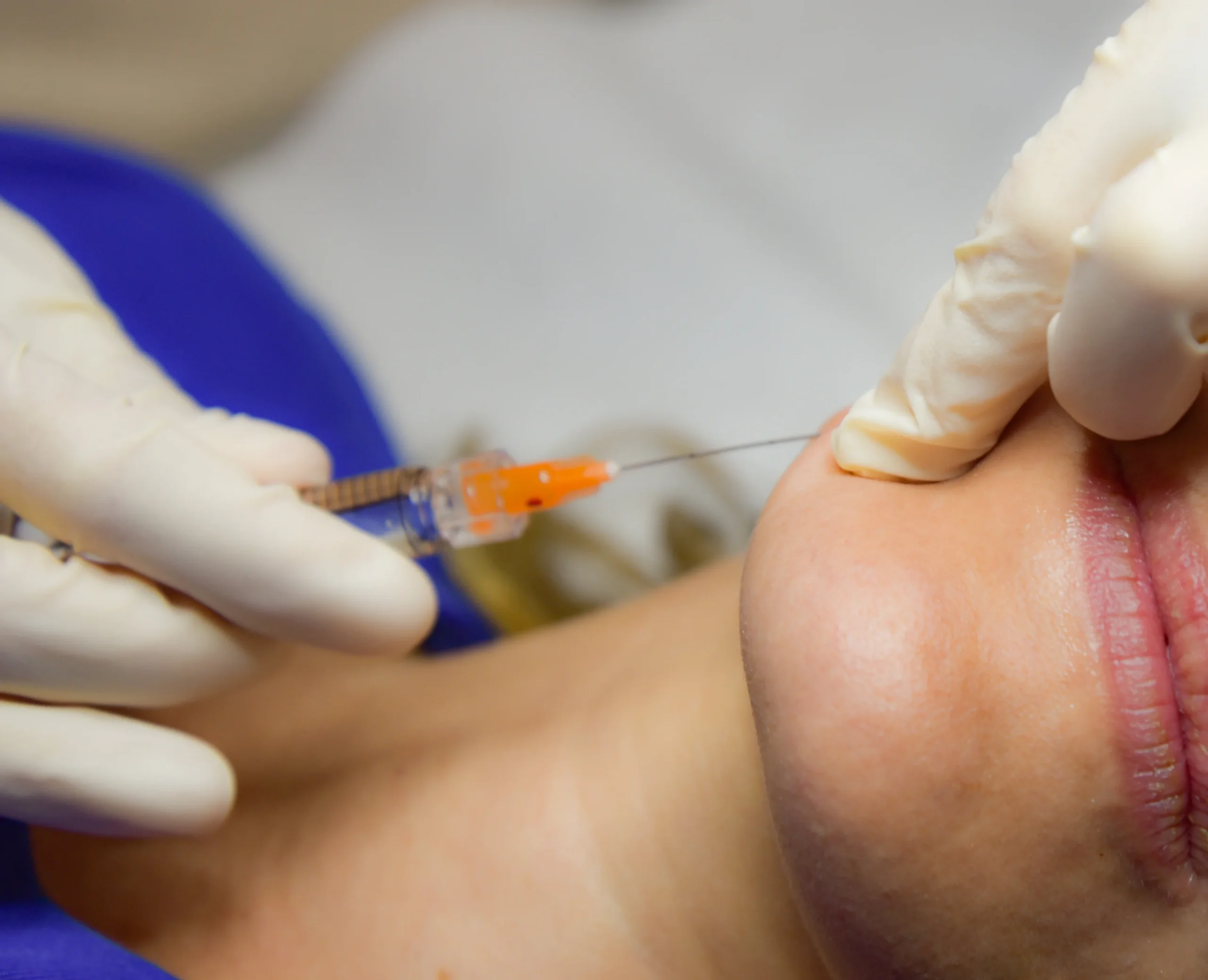 Eliminar arrugas en córdoba